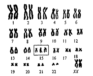 Рис. 1.4. Кариотип человека с трисомией хромосомы 15.